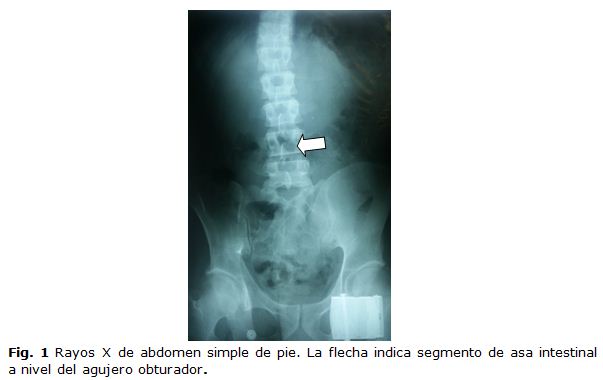 Hernia obturatriz complicada | Correa Martínez | Revista de Ciencias ...